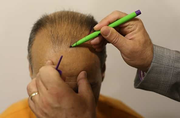 Hair Transplant in Pakistan - Get the Best Hair Clinic.