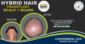 Beard donor area hair use