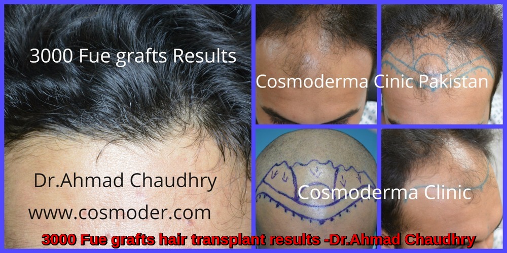 Fue hair transplant 3000 grafts cost in Pakistan