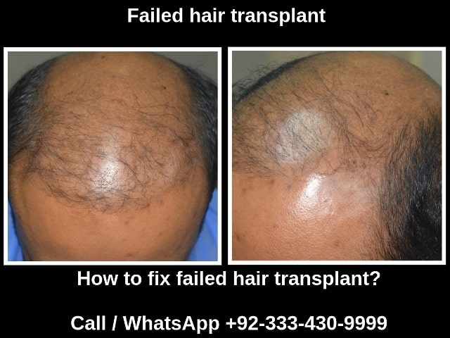 Hair transplant failure | Bad results repair specialist in Pakistan