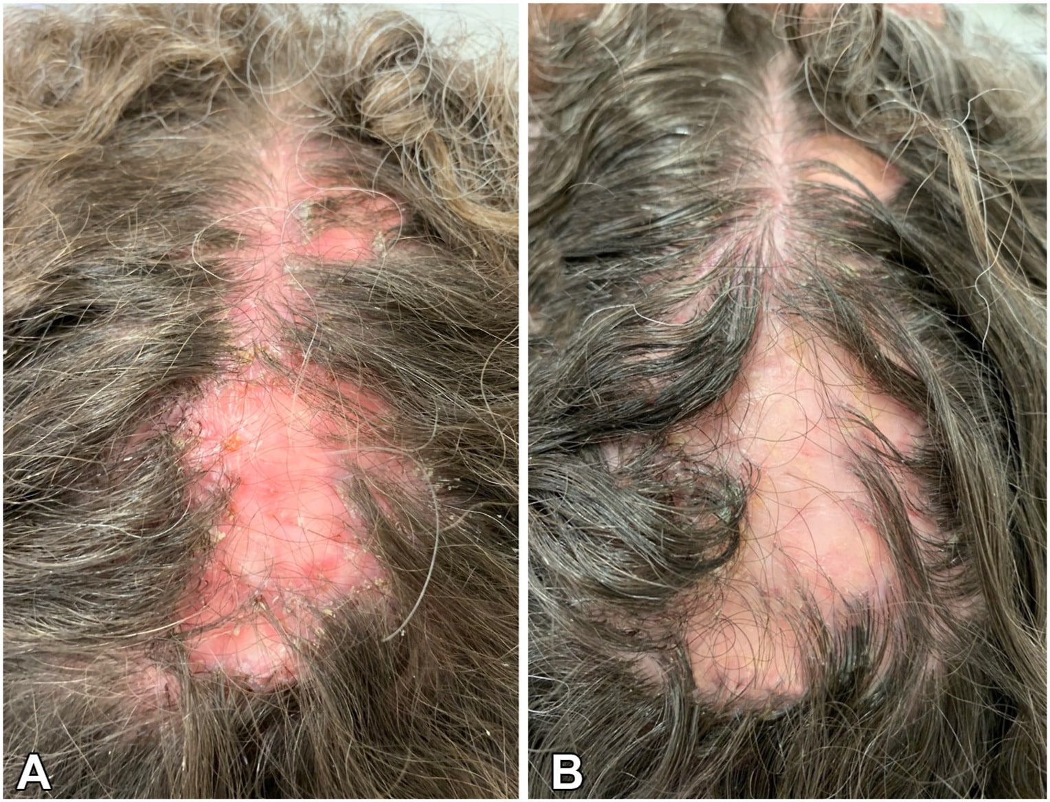 hair transplant surgery after folliculitis possible